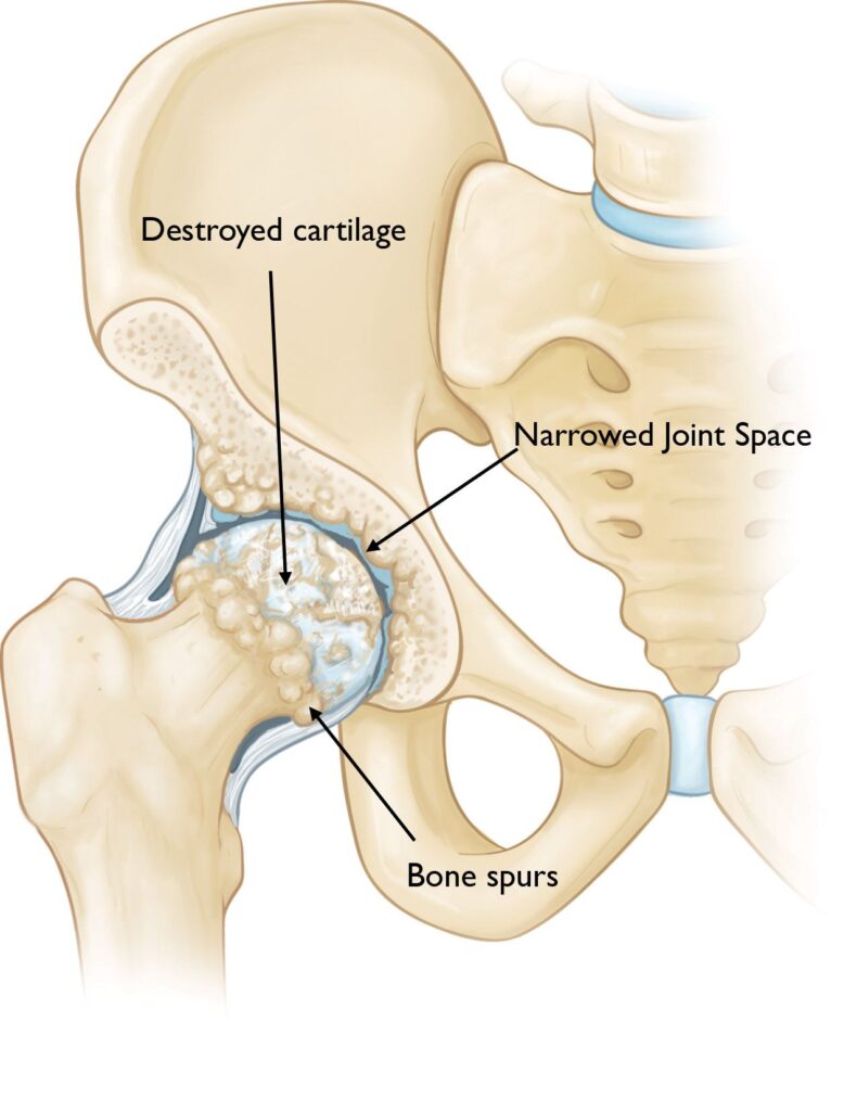 home physio treatment for hip osteoarthritis