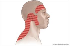Tension Headache Treatment Melbourne. Illustration of pressure areas commonly associated with tension headache.