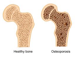 Osteoporosis. Normal Bone versus osteoporotic bone.